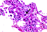 lung pathology showing early organization, mononuclear cell inflammation, and hyperplastic pneumocytes with viral inclusions