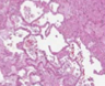 Fibrin thrombi in the small vessels