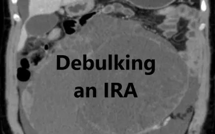 Debulking an IRA